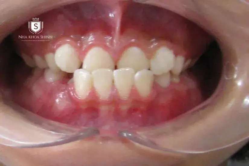 Không bọc sứ khi răng bị lệch khớp cắn nặng