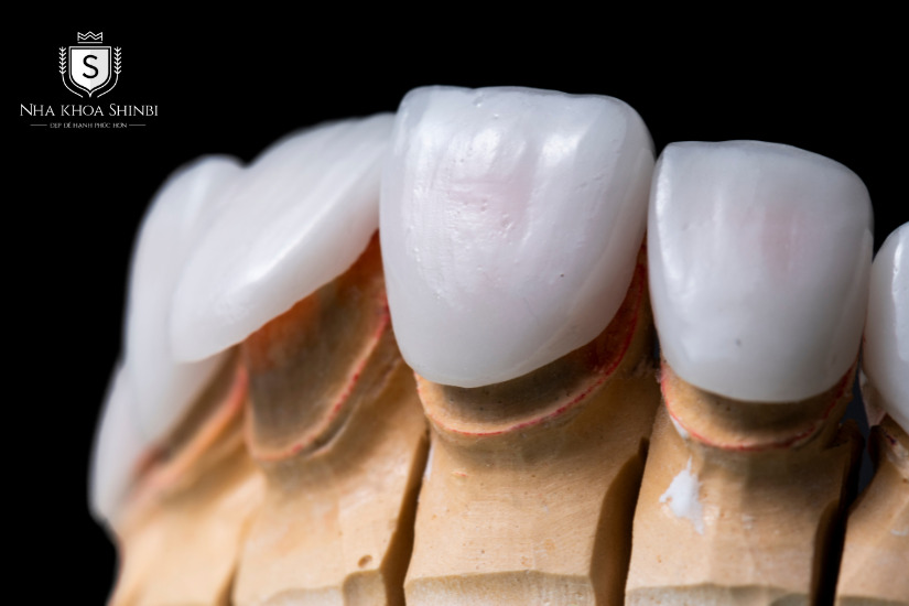 Bọc dán sứ 3D giúp phục hình thẩm mỹ cho răng