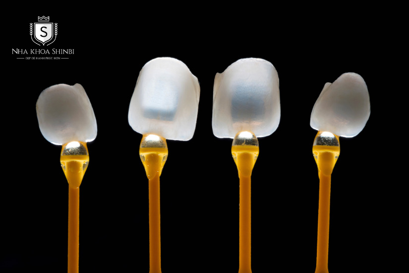 Bọc dán sứ Veneer 3D ngày càng được ưa chuộng