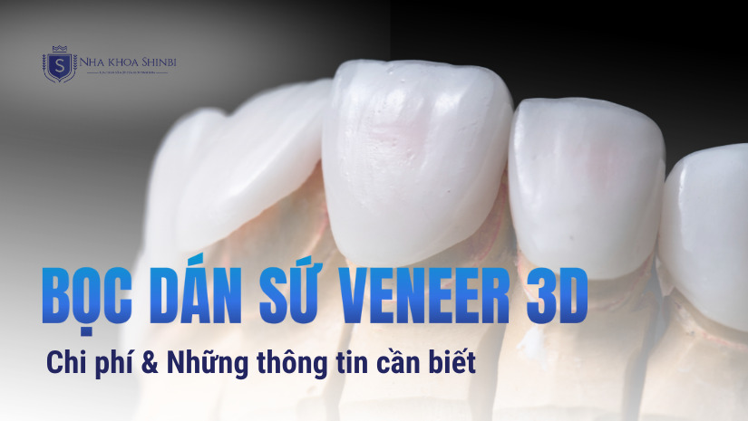 Bọc dán sứ Venner 3D Bọc dán sứ Venner 3D