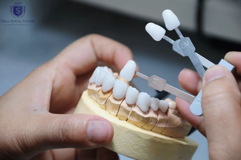 Đánh giá răng sứ Lava: Ưu