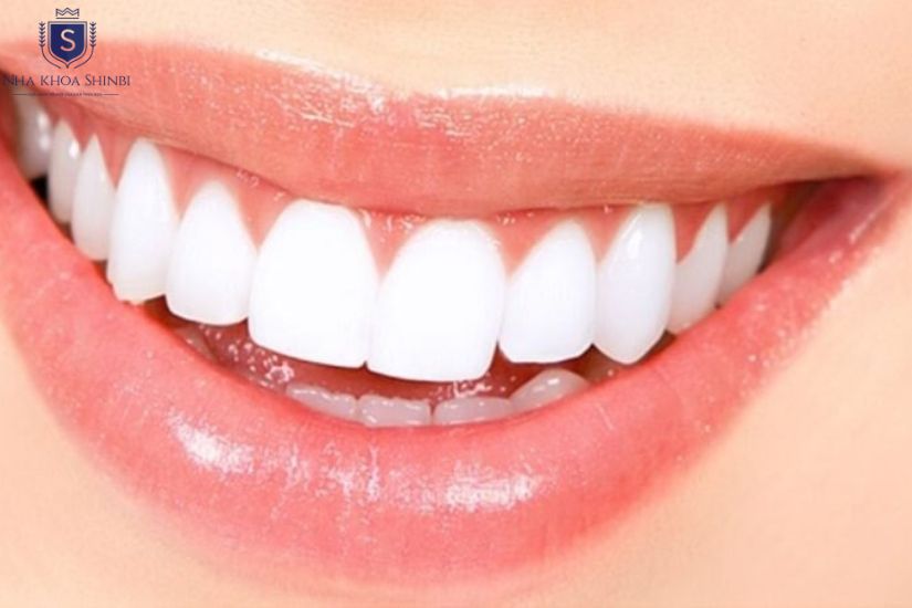 Nhược điểm bọc răng sứ ava