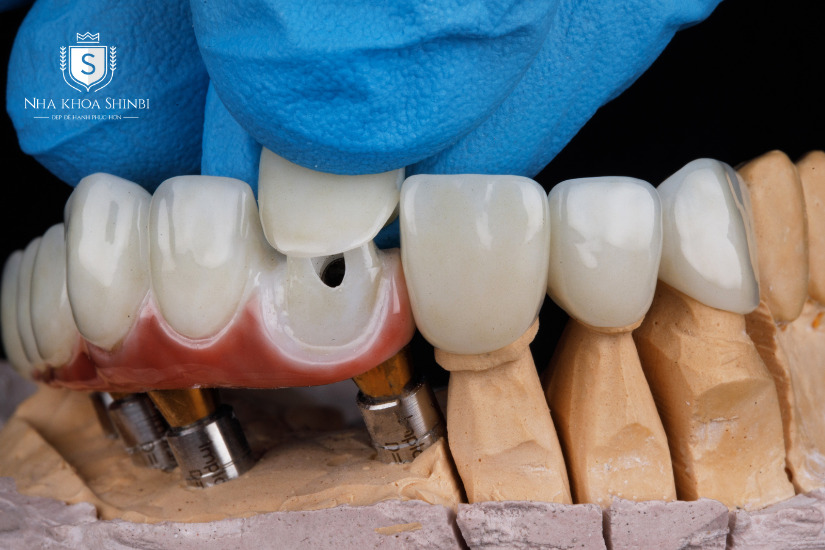 Buổi 2: Bác sĩ hẹn bạn đến để gắn răng cố định Buổi 2: Bác sĩ hẹn bạn đến để gắn răng cố định