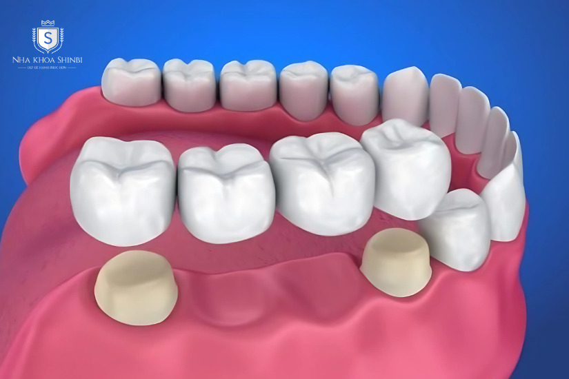 Cầu răng sứ có độ bền kéo dài hơn 10 năm