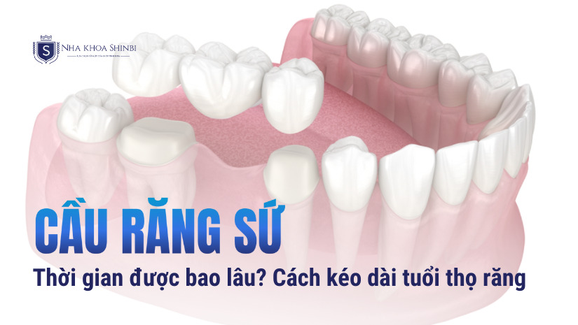 Tuổi thọ cầu răng sứ