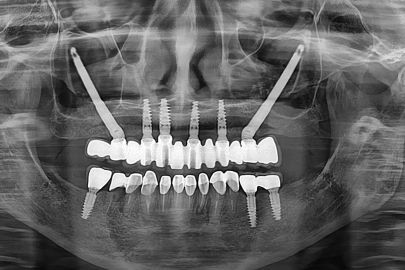 Cấy ghép Implant