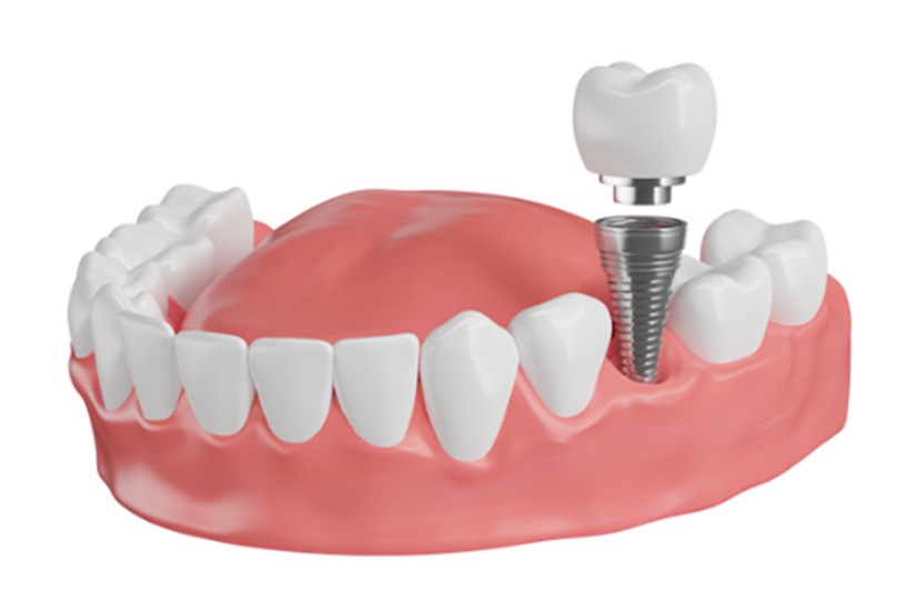 Cấy ghép Implant Cấy ghép Implant