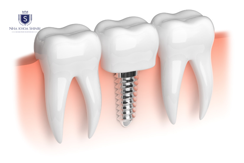Cấy ghép Implant giúp bảo vệ các răng xung quanh