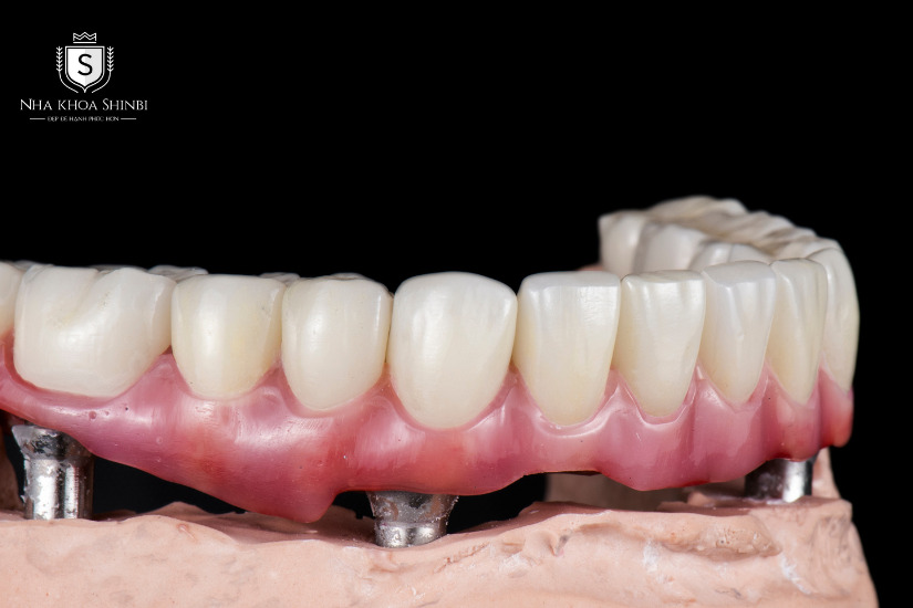 Cấy ghép Implant giúp ngăn chặn biến dạng mặt