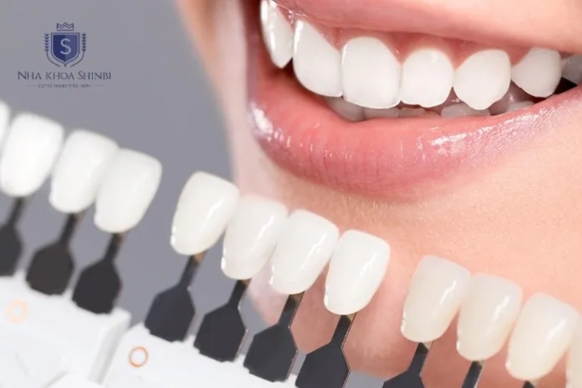 Dán 20 Răng Sứ Trọn Gói Tại Shinbi – Chỉ Từ 10,9 Triệu Đồng!