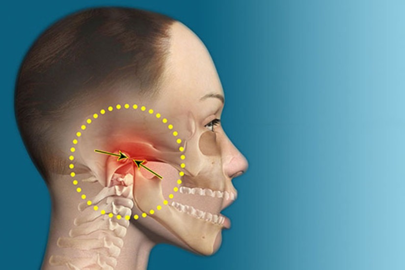 Hội chứng rối loạn khớp thái dương hàm (TMD)/Khớp thái dương hàm (TMJ) & Nhức đầu Hội chứng rối loạn khớp thái dương hàm (TMD)/Khớp thái dương hàm (TMJ) & Nhức đầu
