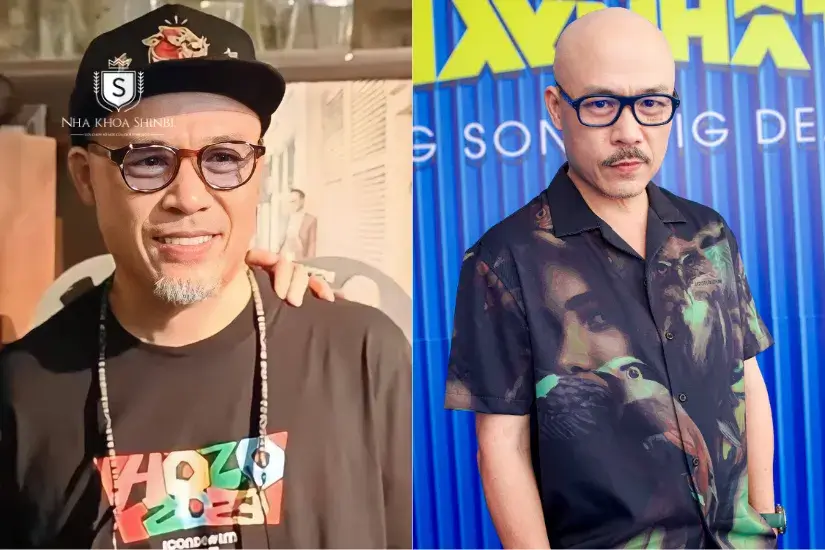 Huy Tuấn bọc răng sứ