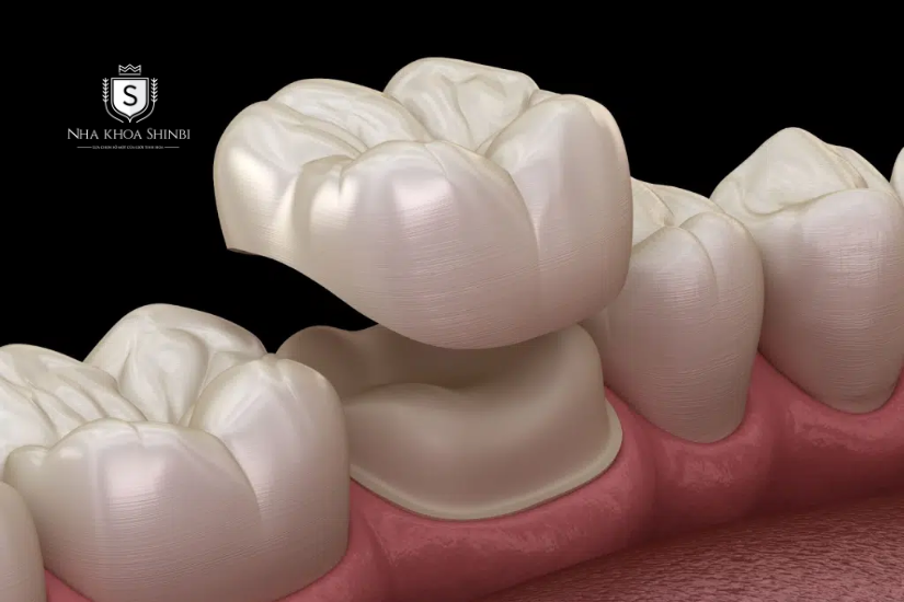 Bọc sứ khi có chân răng tự nhiên hoặc trụ thay thế như implant