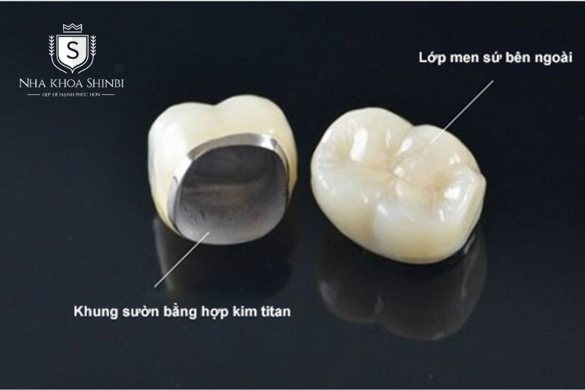 Răng sứ Titan có độ bền cao, giá thành phải chăng