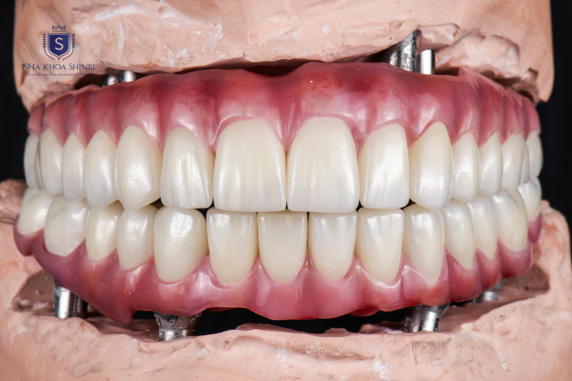 Lợi ích cấy ghép Implant giúp khôi phục chức năng nhai