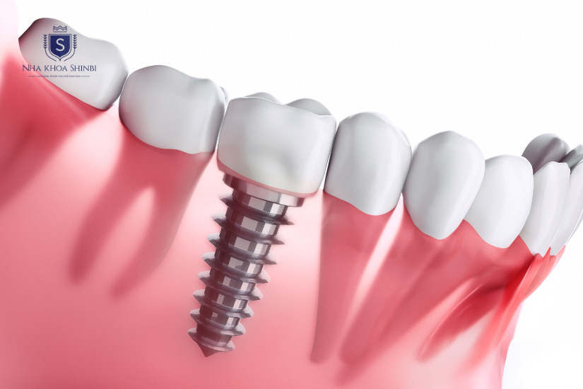 Lợi ích của cấy ghép Implant giúp tăng độ bền của hàm răng