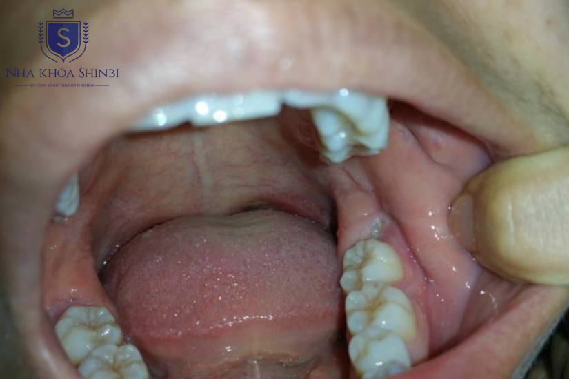Bọc răng sứ khi mô răng còn sót lại nhiều