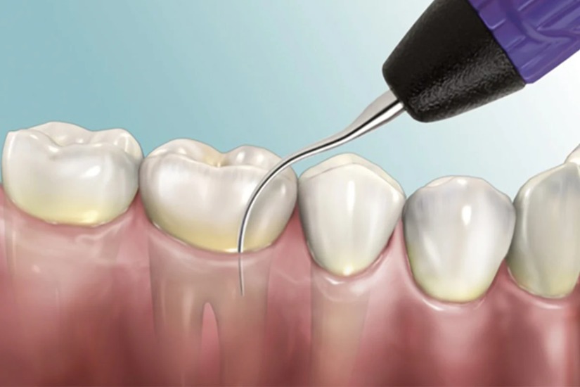 Ưu điểm của Máy Nhổ Răng Piezotome Ưu điểm của Máy Nhổ Răng Piezotome