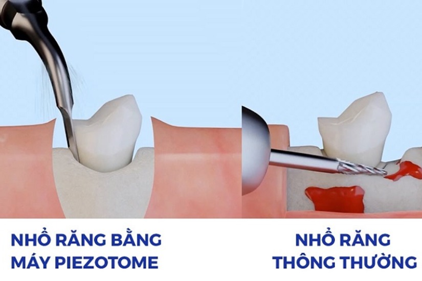 Nhổ răng khôn khó Nhổ răng khôn khó