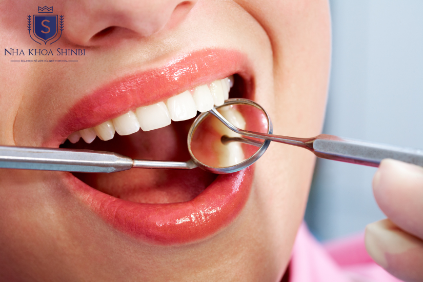Nhổ răng khôn là cần thiết để ngăn ngừa các vấn đề sức khỏe