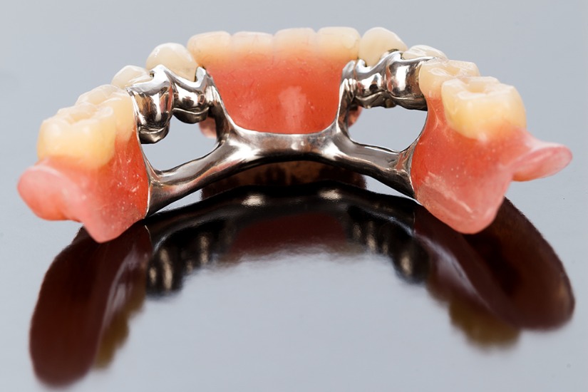 Phục hình mão cầu Phục hình mão cầu