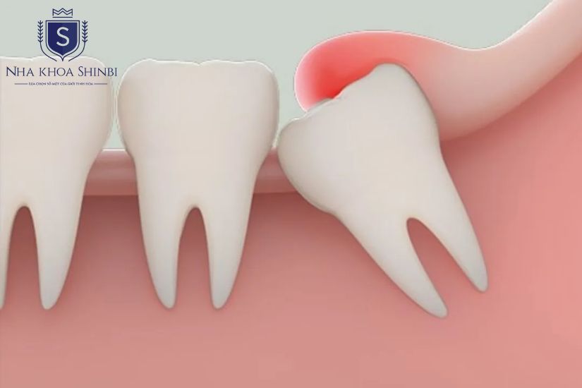 Quy trình nhổ răng khôn toàn tập