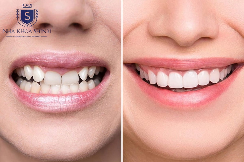 Răng bọc sứ rồi có thể niềng nếu chỉ bọc một vài chiếc
