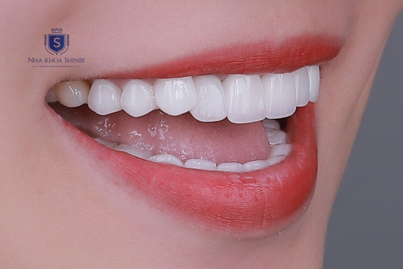Răng lung lay nhẹ cần can thiệp điều trị trước khi bọc sứ