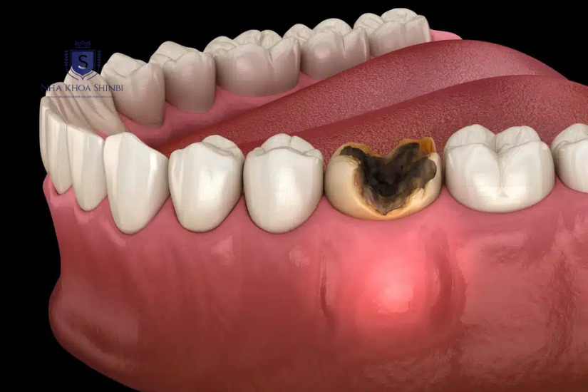 Răng bị sâu nghiêm trọng không nên bọc sứ