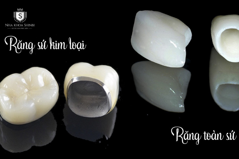 Răng sứ kim loại và răng toàn sứ