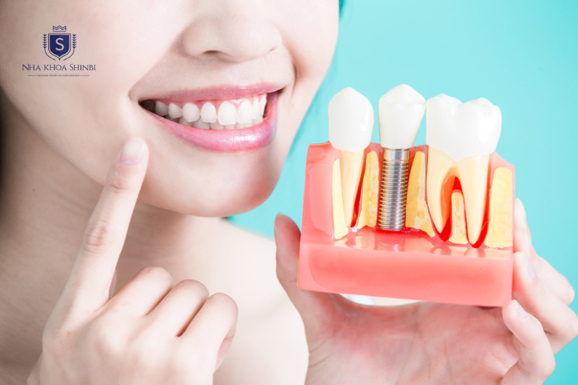 Sau khi cấy ghép, răng sứ đẹp như răng thật
