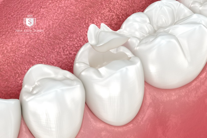 Răng bọc toàn sứ độ bền cao, tuổi thọ 15 - 20 năm