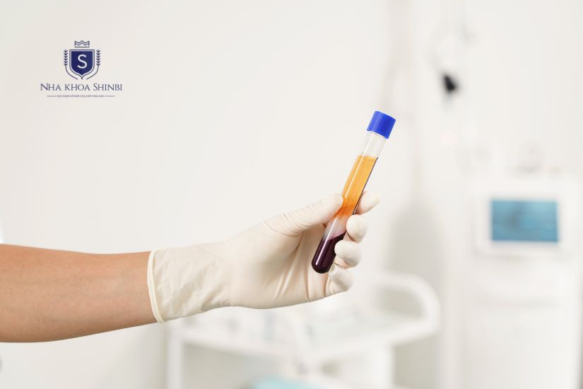 Mẫu máu của bệnh nhân khi quay li tâm để tạo Fibrin giàu tiểu cầu