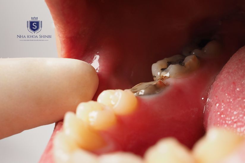 Răng cấm bị sâu