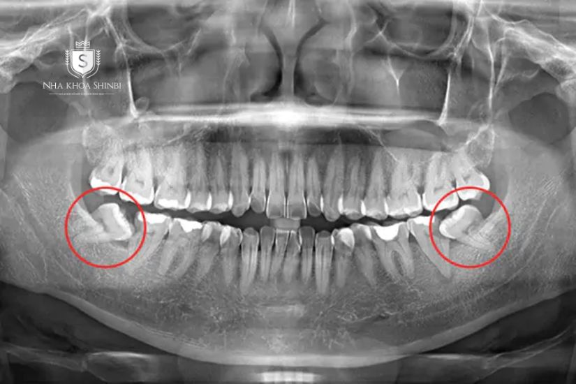 Răng số 7 mọc lệch khi chụp X-quang răng