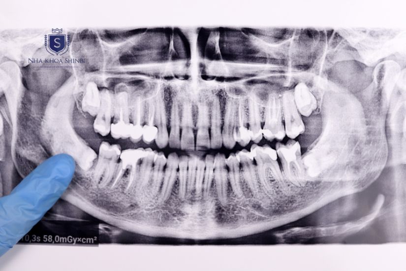Nhổ răng mọc lệch khó