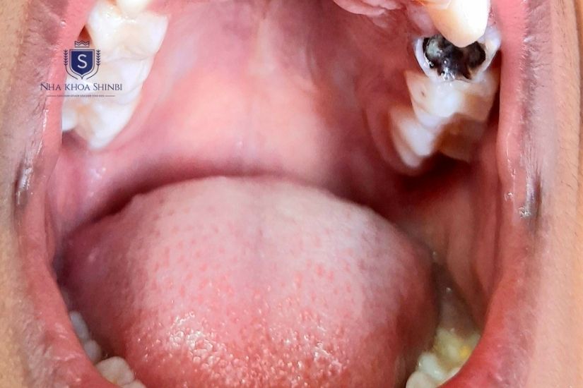 Răng số 6 hàm trên bị sâu nặng