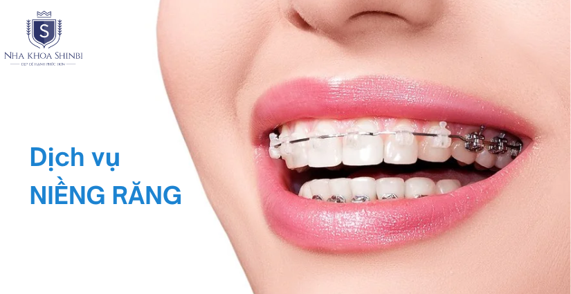 Dịch vụ niềng răng tại địa chỉ niềng răng uy tín ở Hà Nội