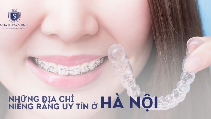 So sánh những địa chỉ niềng răng uy tín ở Hà Nội 