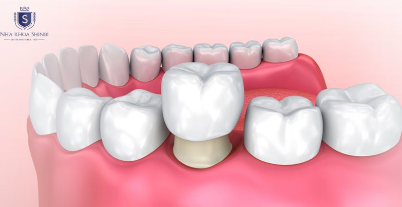Bọc răng sứ thẩm mỹ tốt nhất Hải Phòng
