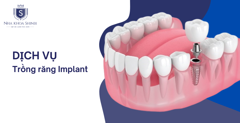 Trồng răng Implant là lựa chọn làm răng sứ tốt nhất Hải Phòng