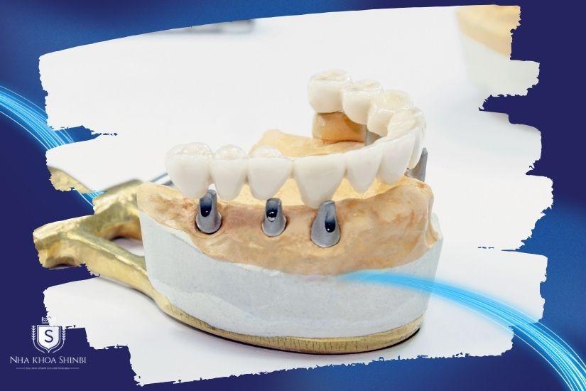 Loại vật liệu răng sứ sử dụng