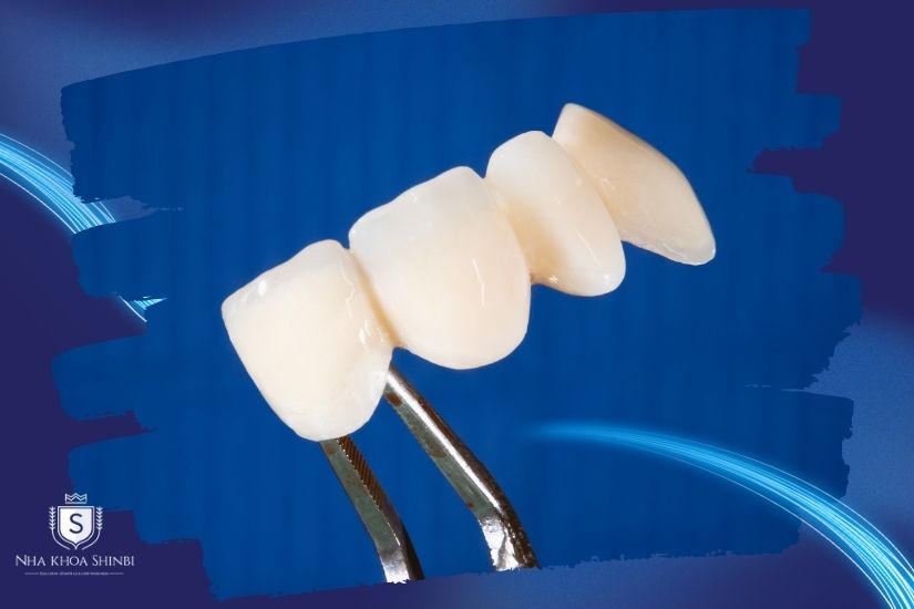 Chi phí bọc răng sứ 2 cái