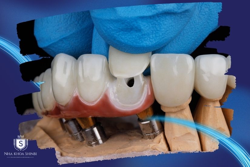 Tình trạng răng ban đầu ảnh hưởng đến chi phí