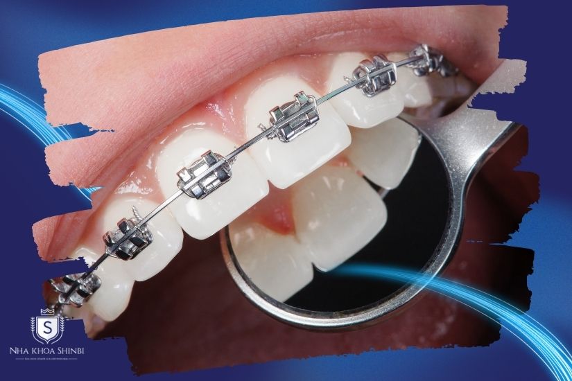 Niềng răng có thẩm mỹ răng sứ được không?