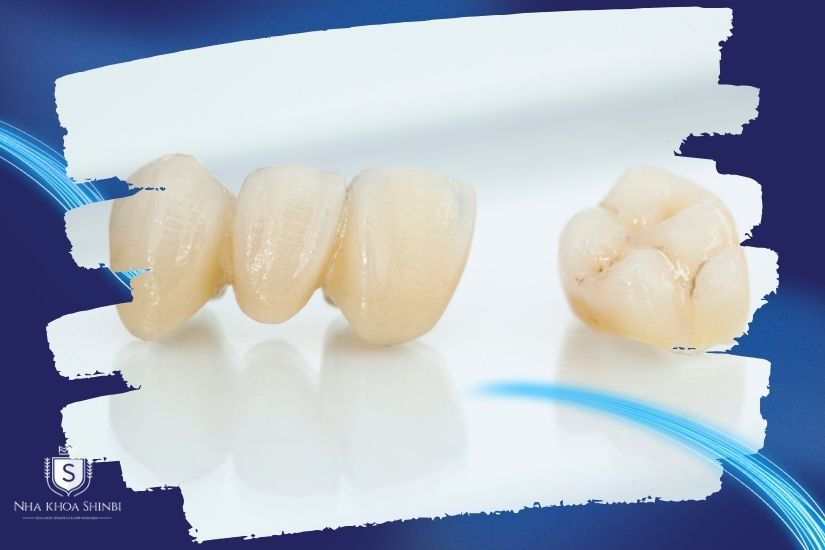 Bọc răng sứ thẩm mỹ
