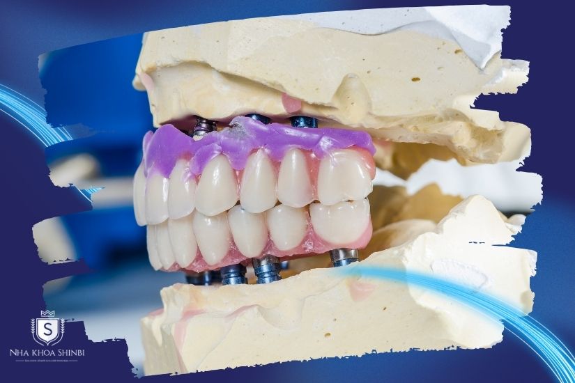 Chất liệu răng sứ chính hãng
