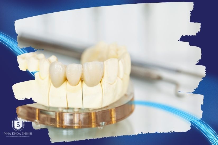 Khám phá bọc răng sứ trong bao lâu