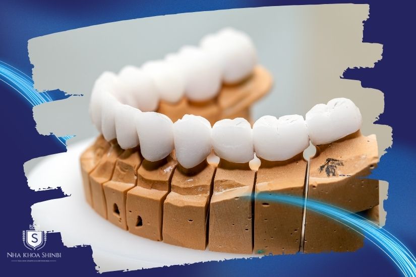 Loại răng sứ lựa chọn