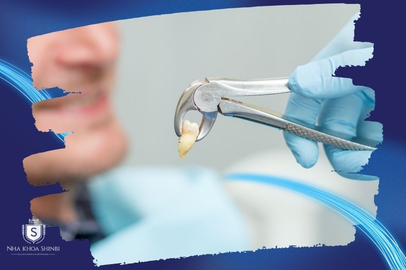 Nhổ răng khôn truyền thống bằng kìm và bẩy
